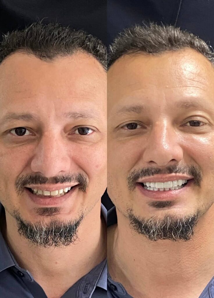 Lentes de Contato Dentais Cuidados