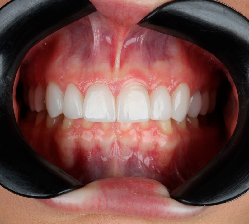 Lentes de Contato Dentais Cuidados