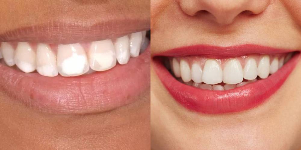 Manchas nos Dentes