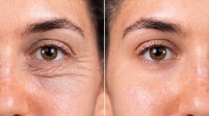 blefaroplastia